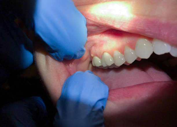 Best Emergency Wisdom Tooth Extraction in Stevensville, MI